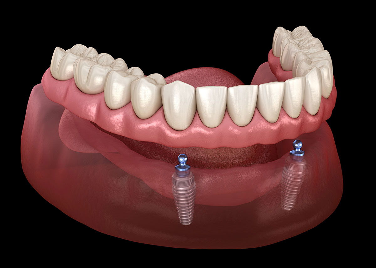 Snap-on Denture