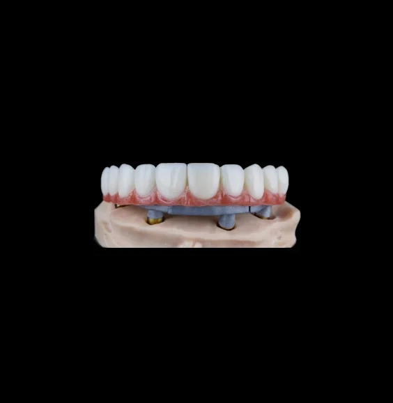 Full Arch Implant Denture
